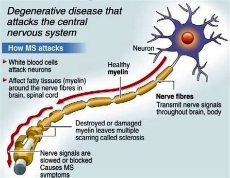 health multiple sclerosis