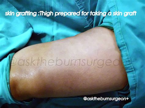 burn surgeon      skin grafting part ii