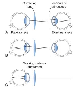 retinoscopy american academy  ophthalmology
