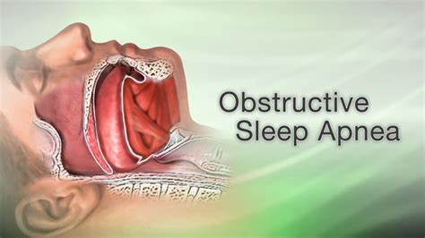 obstructive sleep apnea does your significant other