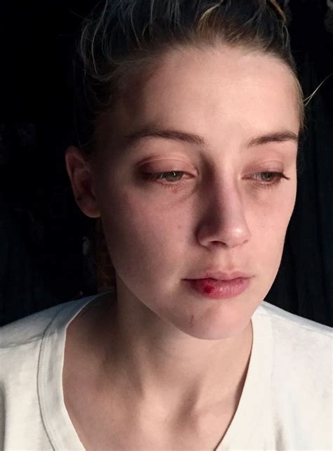 Amber Heard S Bruised Face Pictured As Johnny Depp Admits