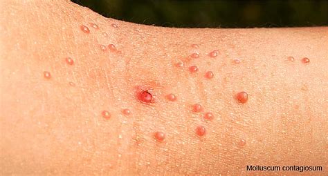 Early Symptoms Of Hiv In Women Infections And Rashes