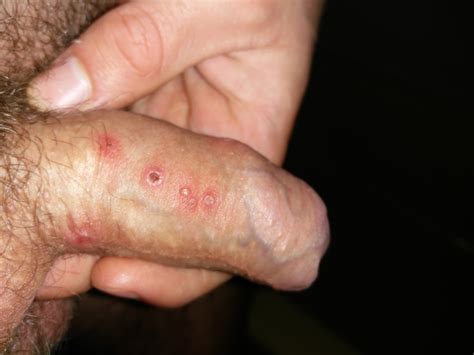 blister on penis web sex gallery