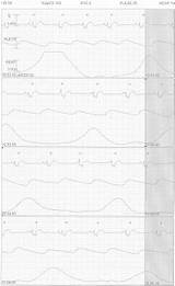 Valve Cardiology Pedi Stridor Bioprosthetic Paralysis Tricuspid Intermittent sketch template