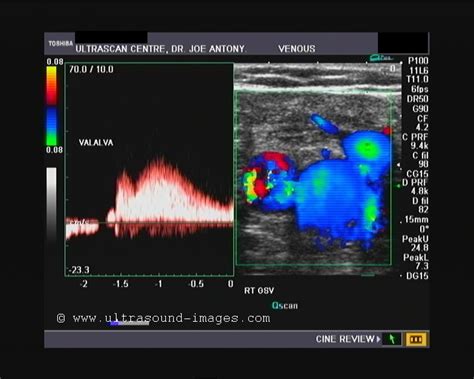 ultrasound  color doppler  ultrasound video sapheno femoral incompetence part