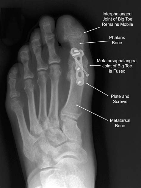 big toe arthritis daniel bohl md midwest orthopaedics  rush