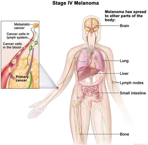metastatic stage 4 melanoma life expectancy and metastatic melanoma