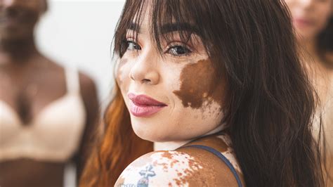 prevent vitiligo  spreading northernpossession