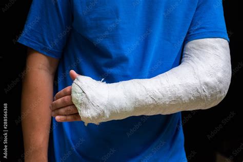 man  broken arm wrapped medical cast plaster fiberglass cast