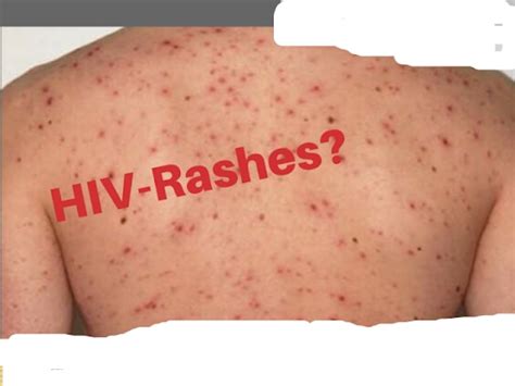 rash can occur in many conditions and any type of rash can