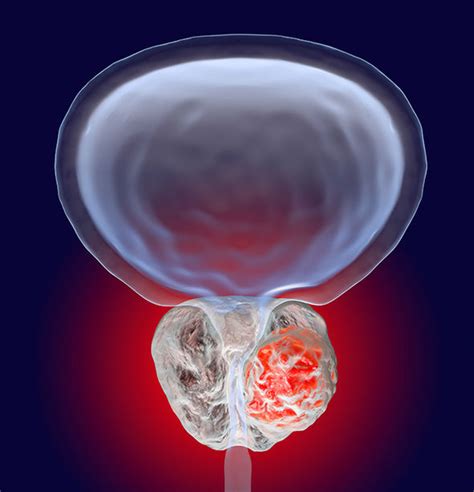 prostate cancer signs symptoms and treatment what are the risks of