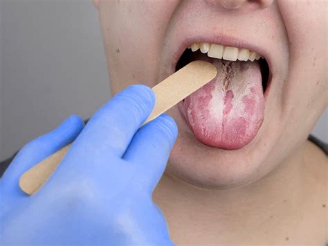 yeast infection in mouth causes treatment and prevention