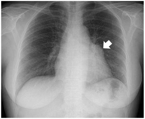 Abnormal Chest X Ray Results