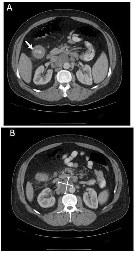 Colon Cancer Metastasis To Mediastinal Lymph Nodes Without Liver Or