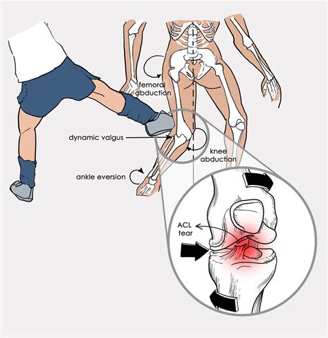 acl injury physiocure
