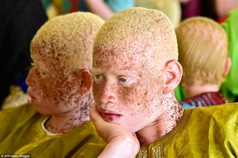 Albinos Around World Gather For International Albinism Awareness Day