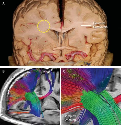 high definition fiber tractography   human brain neuroanatomical