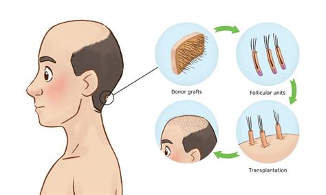 Male Pattern Baldness Treatment In Jaipur Hair Loss