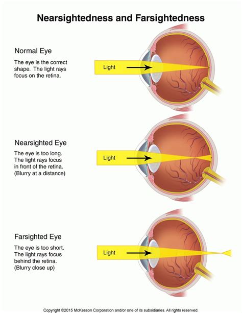 nearsightedness and farsightedness illustration tufts