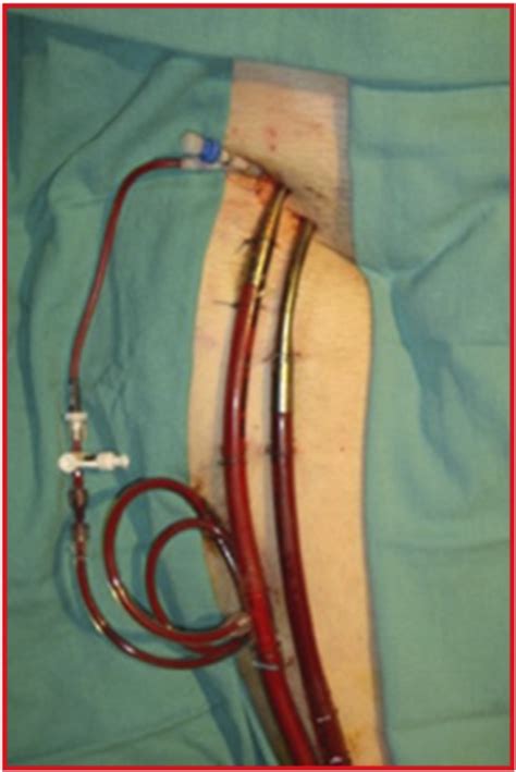 resuscitative extra corporeal life support ecmo   ed