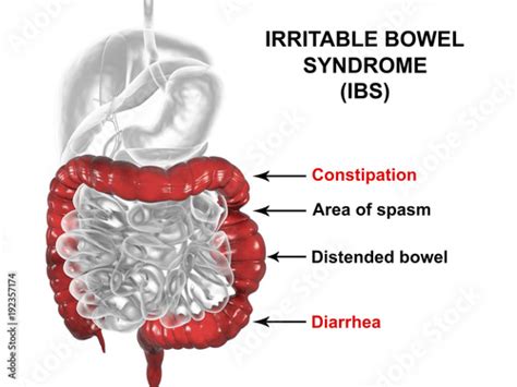 Irritable Bowel Syndrome Ibs Medical Concept 3d Illustration Showing
