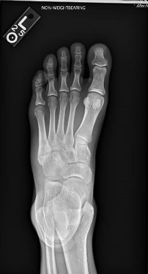 Case Report Fifth Metatarsal Fracture Sports Medicine Review