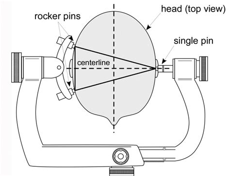 Fda Warns Of Skull Clamp Slippage