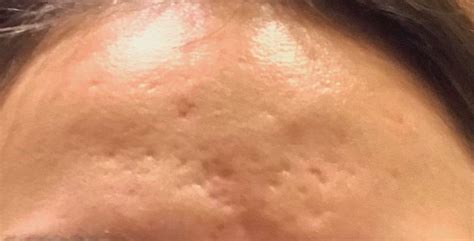 [acne] [skin concerns] forehead acne scars completely lost as to