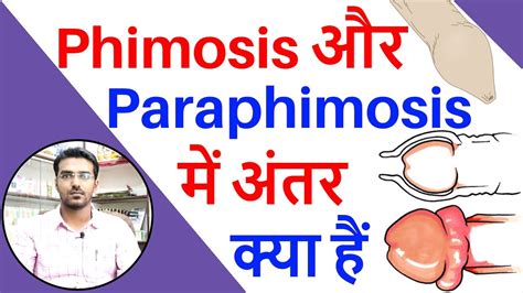 Phimosis या लिंग की चमड़ी चिपक जाने का इलाज Phimosis Treatment In