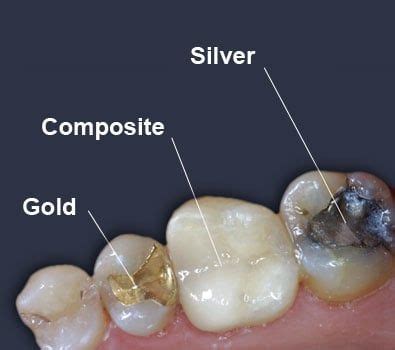 types  fillings dental teeth fillings salinas dental  implant