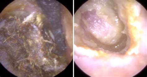 Doctors Remove Masses Of Thick Yellow Earwax From Man S Ear Metro News