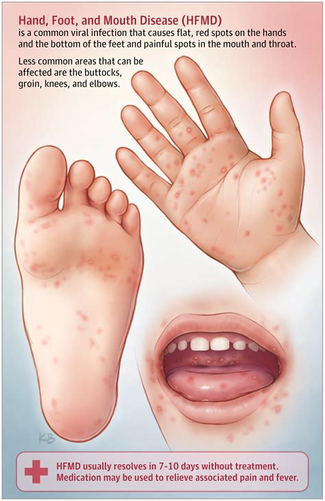 hand foot and mouth disease dermatology jama jama network