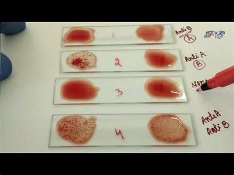 blood grouping reverse blood grouping method principle procedure  hindi serum grouping