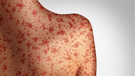 measles symptoms  signs  outbreak  adults  kids