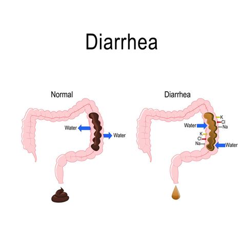 diarrhea harvard health