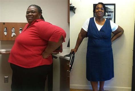 I Cheated After Gastric Bypass