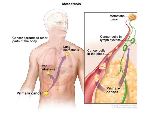 metastatic cancer when cancer spreads nci
