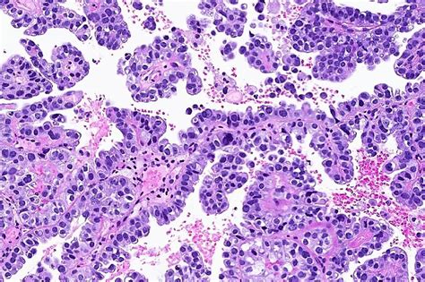 Clear Cell Carcinoma Uterus Mypathologyreport Ca