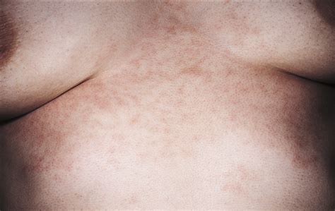 erythematous rash on the chest dermatology jama dermatology jama