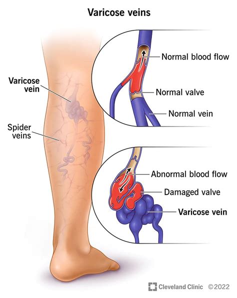 vascular vein removal cosmetic surgery tips