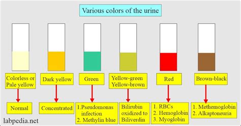 urine analysis complete discussion part  labpedianet