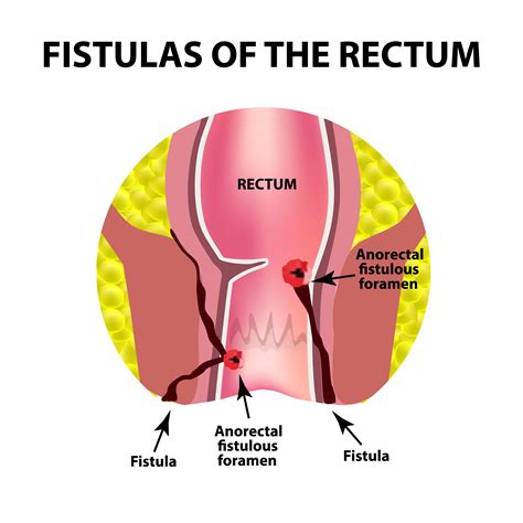 rectal fistula symptoms diagnosis and treatment healthsoul