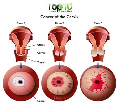 10 warning signs of cervical cancer you should not ignore ~ health