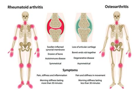 osteoarthritis  rheumatoid arthritis jointfuel official