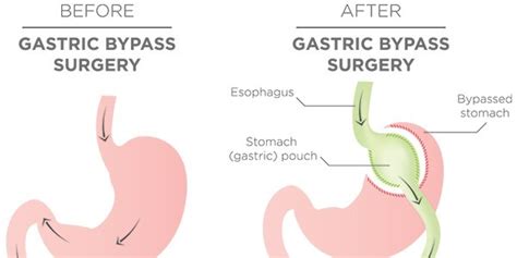 5 Ugly Things I’ve Learned About Gastric Bypass Surgery