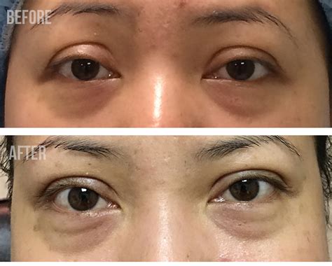 Asian Eyelid Surgery Center Cosmetic And Asian Double Eyelid Surgery