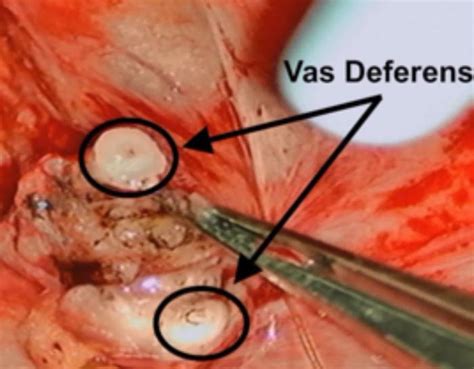 vasectomy reversal uc davis health department of urologic surgery