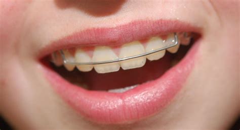 ارتودنسی دندان کلینیک ترمیم و پر کردن دندان ایرانیان