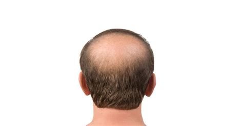 regrow hair   bald spot  science backed methods