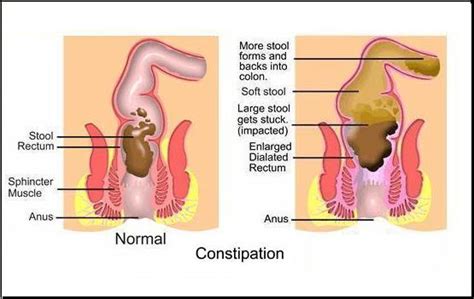 natural remedy for constipation ways to choose best online portals for natural constipation